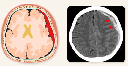 급성_경막하_출혈_CT