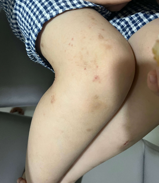 보건소 아토피사업 신청방법 