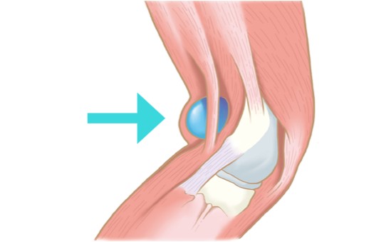 오금이-아픈-이유