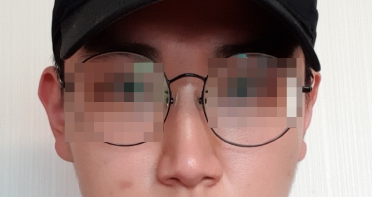 비중격 만곡증 수술 후기