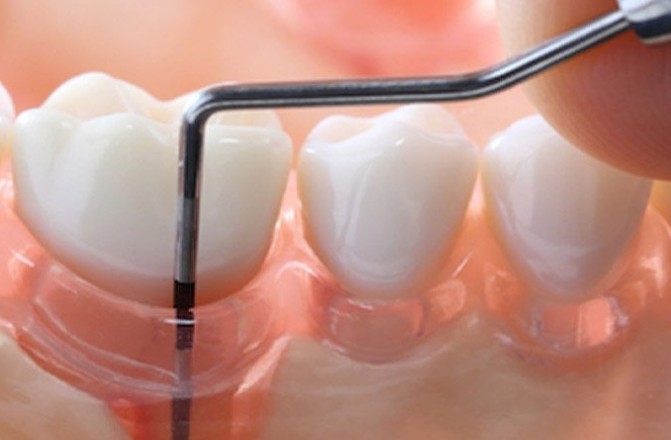 치주질환 증상 치료 비용 방법 - 잇몸 피, 치아흔들림, 잇몸뼈녹음 재생