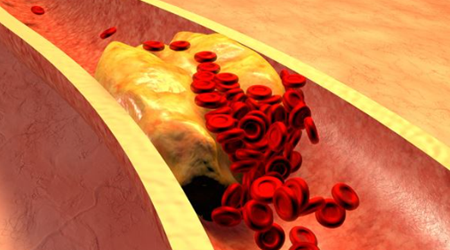 콜레스테롤 낮추는 방법
