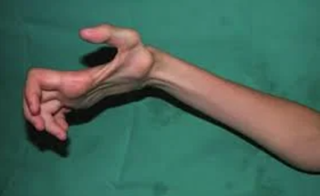 볼크만허혈성구축