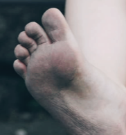 티눈 없애는 방법