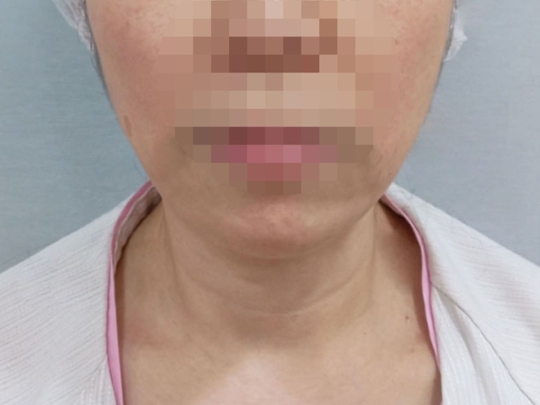 얼굴다이어트 볼살제거 얼굴살제거 브이라인지방이식 부천지방흡입 부천지방이식 얼굴지방흡입