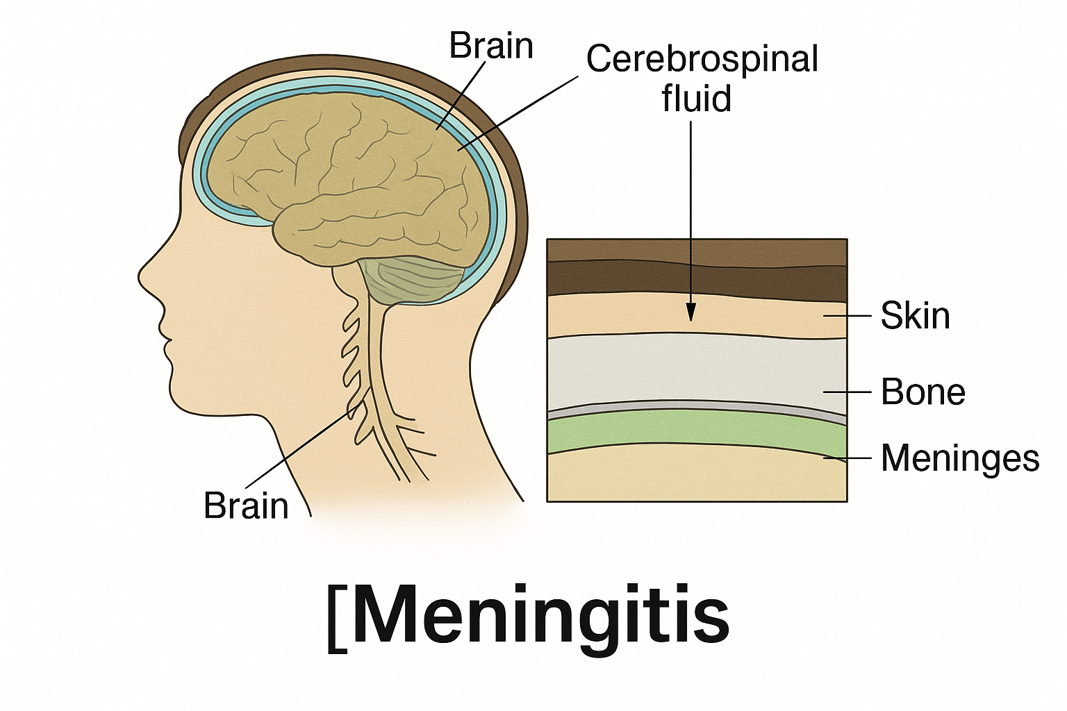 뇌수막염 관련사진
