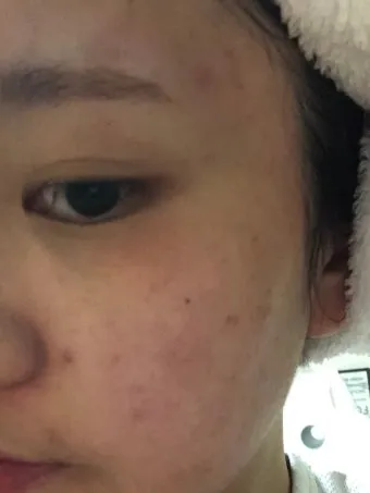 에로콤크림 코르티코이드 반응성 피부질환에서의 염증가려움 완화 전략에 대한 사용수칙_9