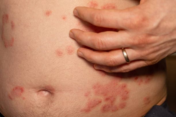 두드러기와 체중/비만: 지방세포와 염증의 연결고리