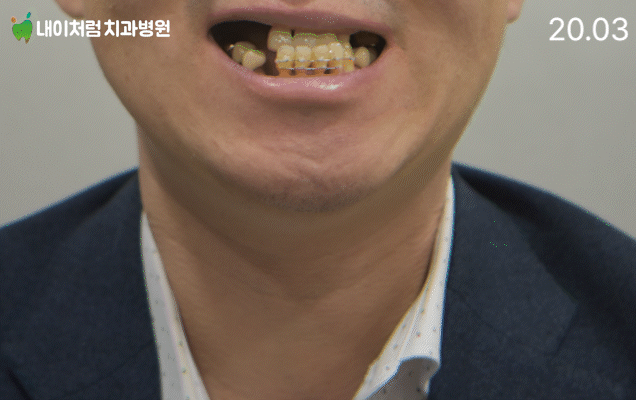 서울치과 이수역 내이처럼 전체 임플란트 전후