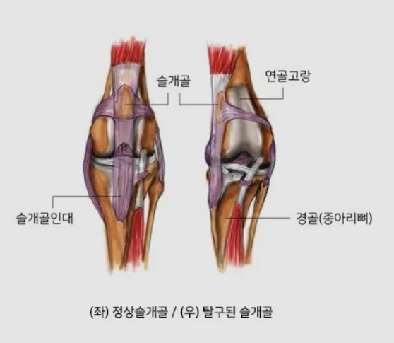 강아지 슬개골 탈구 수술 후유증_9