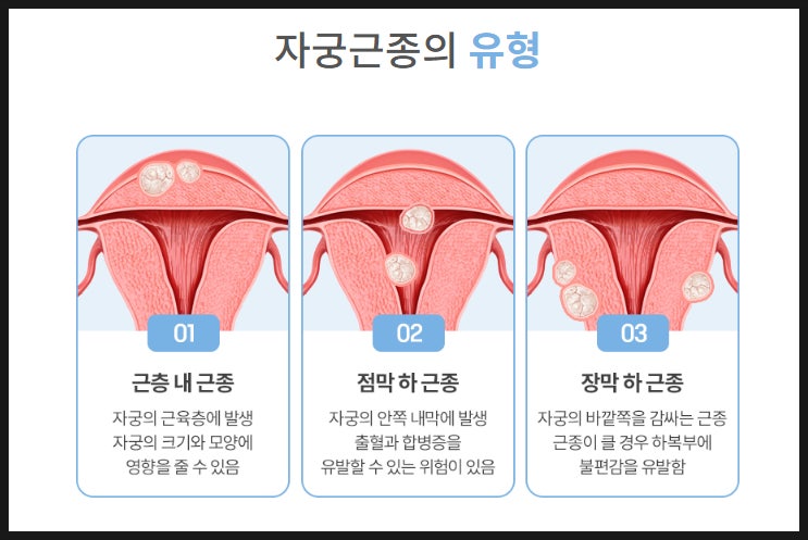 자궁근종, 자궁근종 증상, 자궁근종 원인, 자궁근종 치료, 자궁근종 수술, 자궁근종 크기, 자궁근종 예방, 여성 질환, 자궁 건강, 생리과다,자궁근종, 자궁근종 증상, 자궁근종 원인, 자궁근종 치료, 자궁근종 수술, 자궁근종 크기, 자궁근종 예방, 여성 질환, 자궁 건강, 생리과다,자궁근종, 자궁근종 증상, 자궁근종 원인, 자궁근종 치료, 자궁근종 수술, 자궁근종 크기, 자궁근종 예방, 여성 질환, 자궁 건강, 생리과다