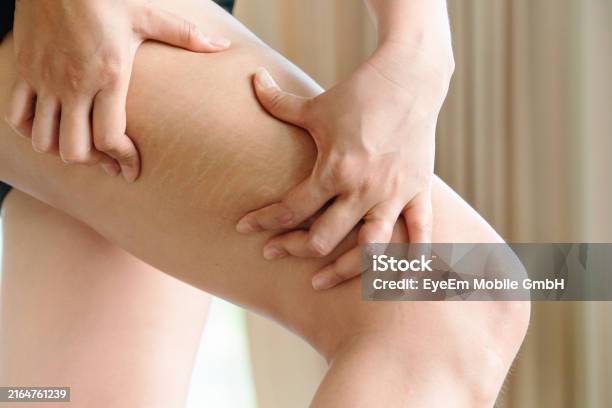 튼살 관련 사진