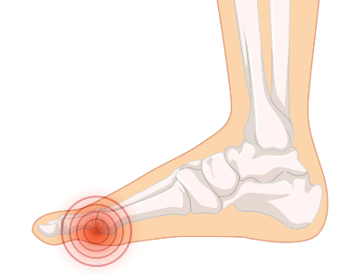 지간신경종-중족골통