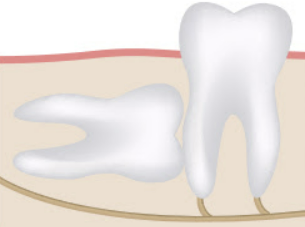 사랑니 발치후 식사 알아보기 커피, 흡연, 음주 정보