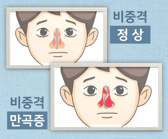 비중격-만곡증이란