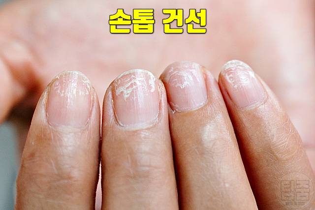 손톱 하얀 반점 손톱흰반점 손톱흰색가로줄 원인 건선