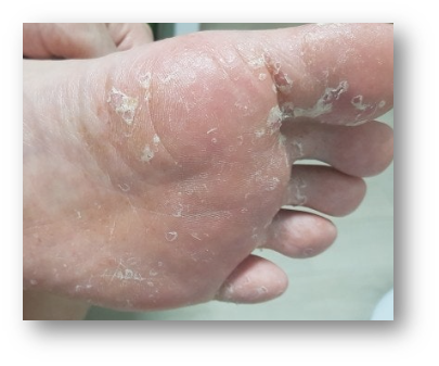 발바닥과 손바닥 껍질 벗겨짐