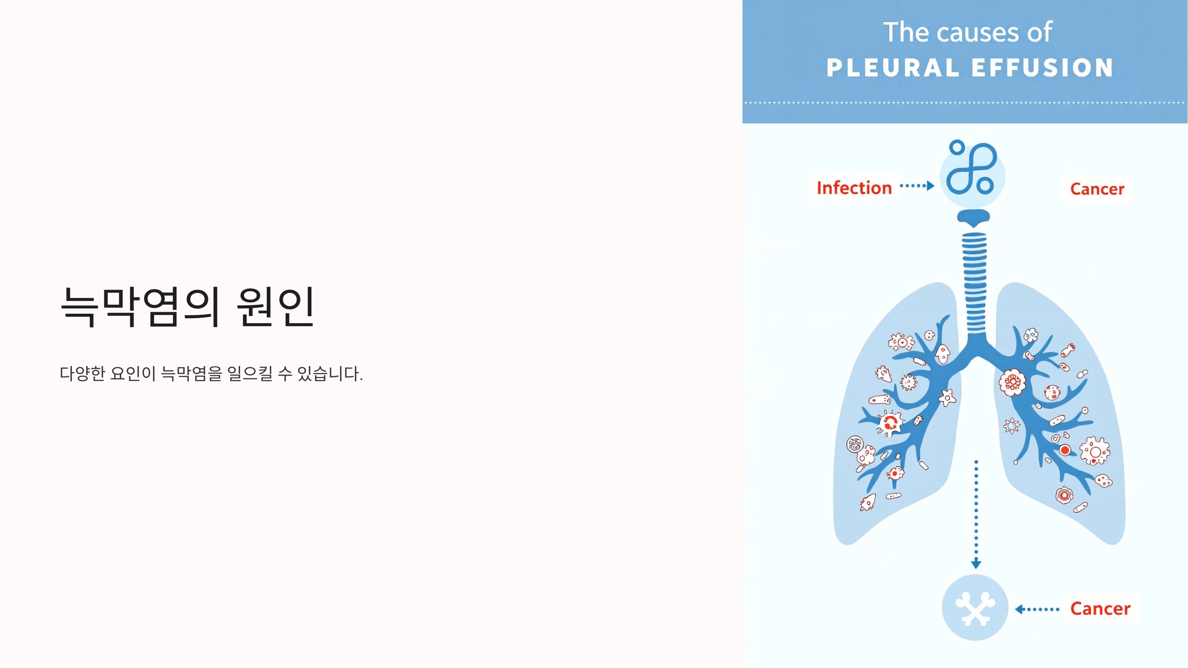 늑막염과 관련된 사진입니다.