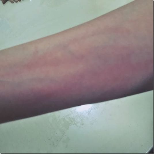 피부묘기증 주요 증상