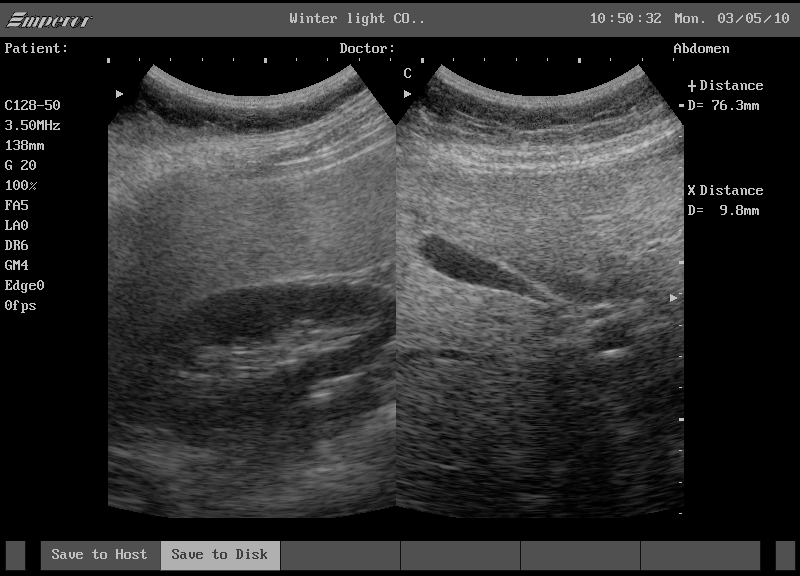 복부 초음파로 알 수 있는 것