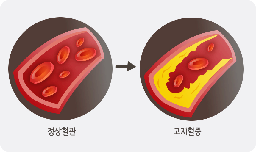 고지혈증