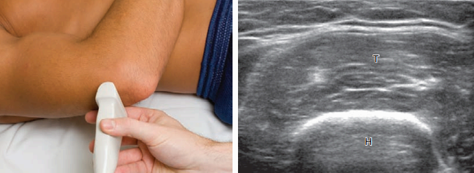 뒤쪽검사(posterior)