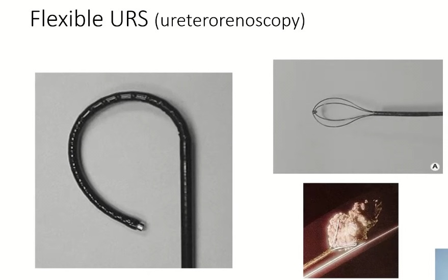 요로결석-명의-구교철-교수-체외충격파