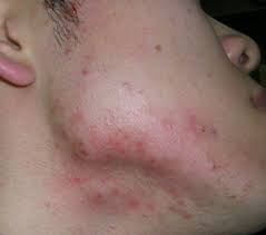 지루성 피부염 완치하려면