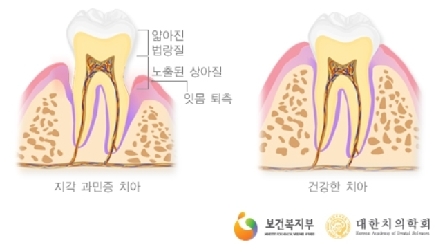 법랑질이 얇아져 상아질이 노출 된 형태