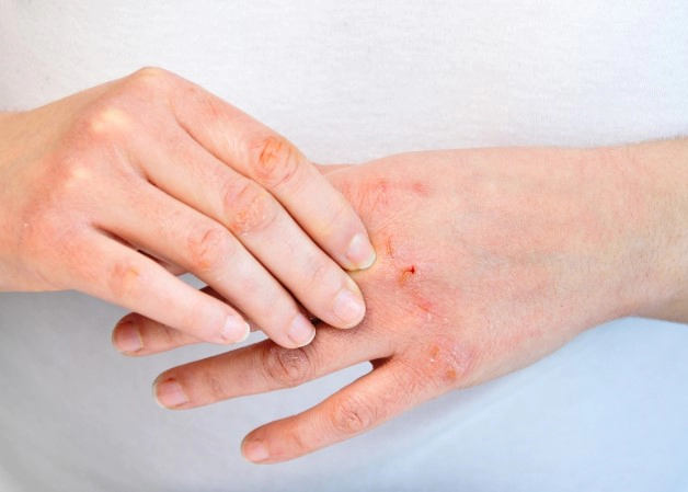 아토피에 좋은 오일 추천