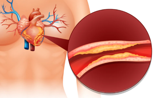 이상지질혈증-동맥경화-심혈관질환