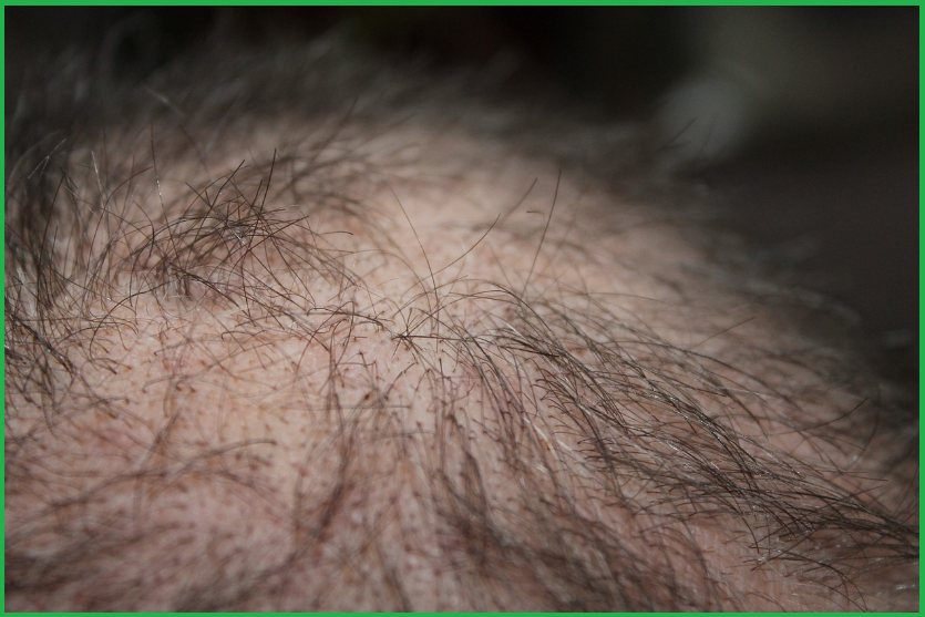 탈모 원인- 왜-머리카락이-빠질까?