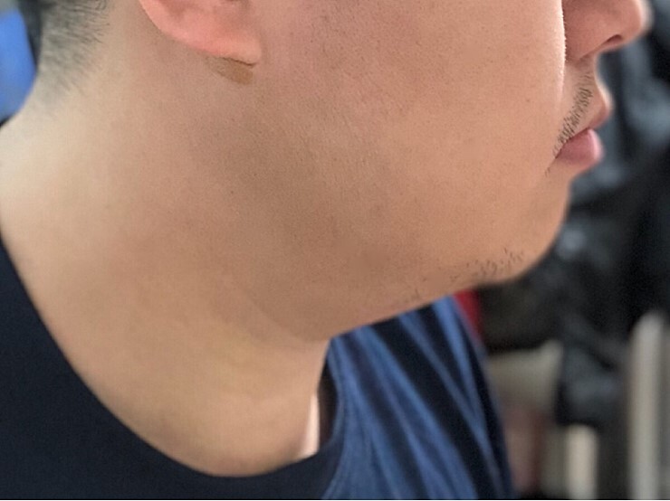 얼굴 지방흡입 후기