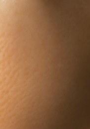 유방암 초기증상