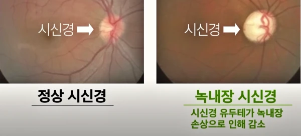 정상 시신경과 녹내장 시신경을 비교 설명해주는 사진으로써 시신경 유두테의 손상 정도를 촬영을 통해 확인할 수 있습니다.