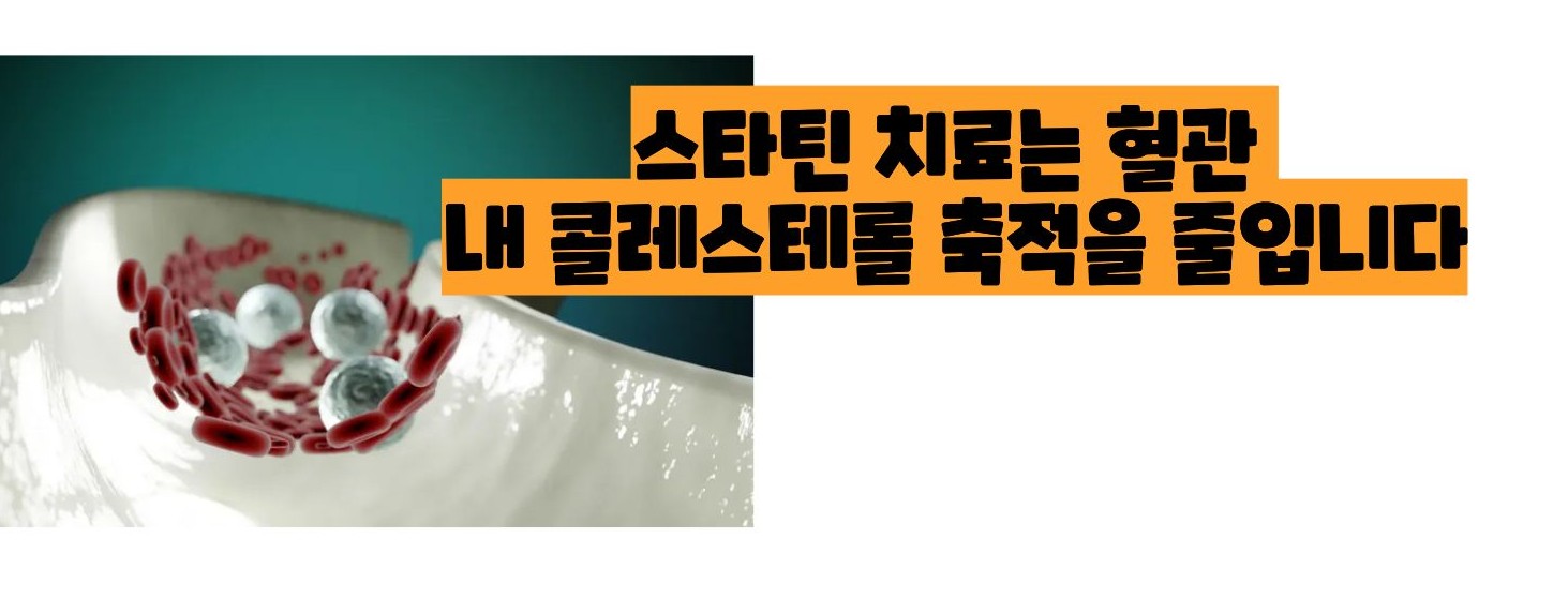 경동맥 협착증 치료