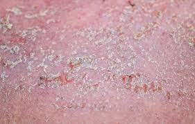 지루성 피부염 완치하려면