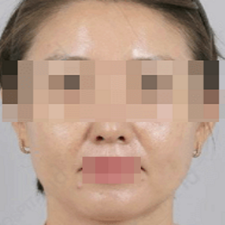 인모드 시술 전 여성의 모습 사진