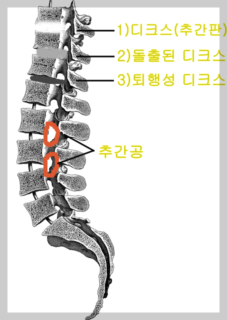 퇴행성 디크스의 진행단계