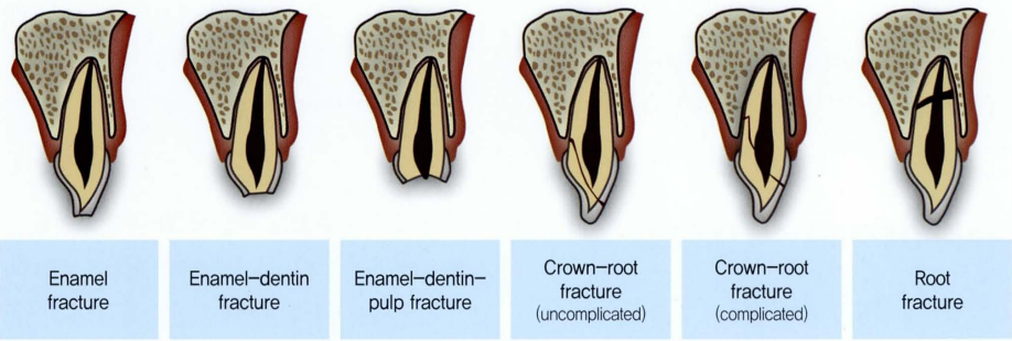 치아 파절의 유형