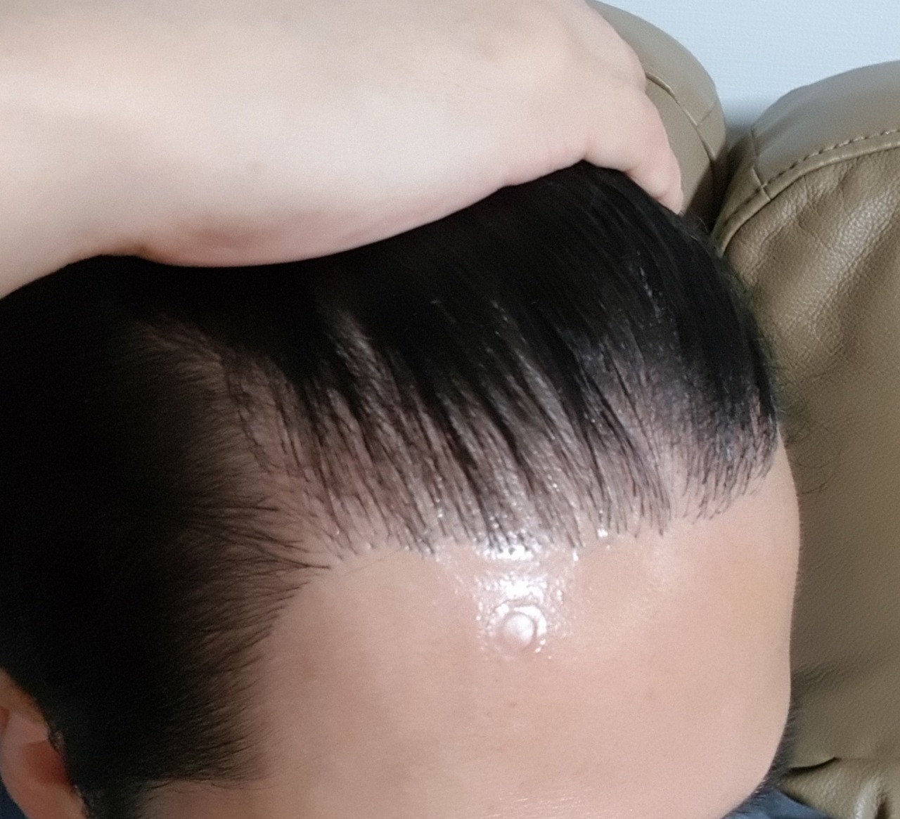 모발이식 후기
