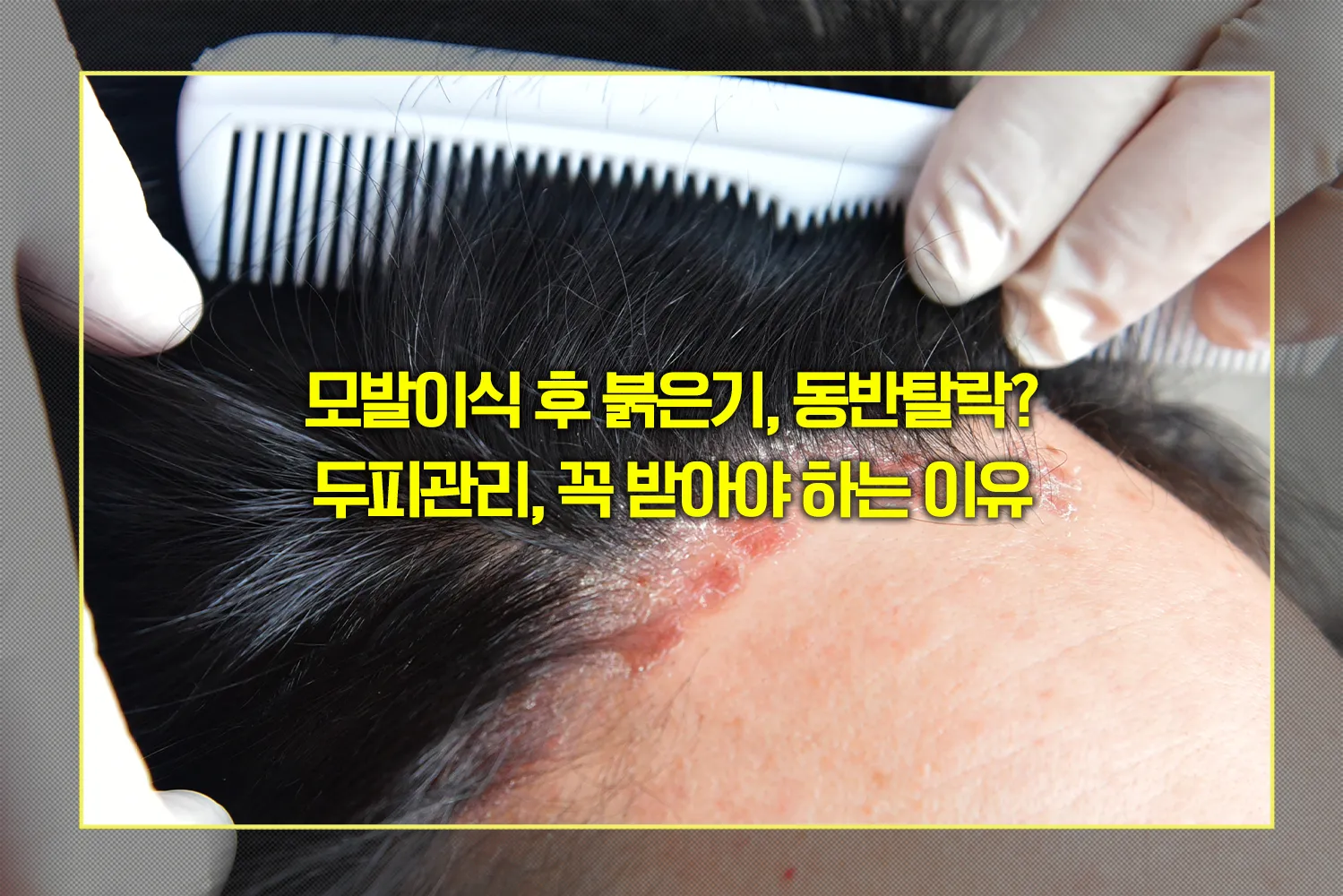 모발이식-후-두피관리-생착률-회복법