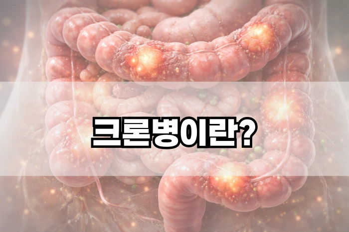 크론병이란