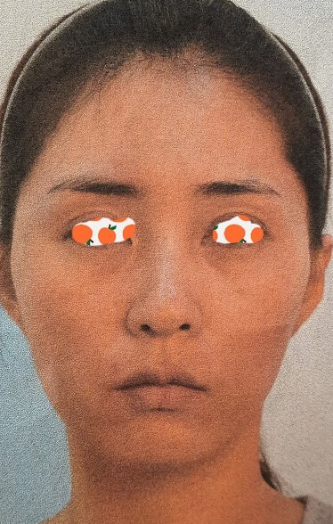 얼굴지방이식후기