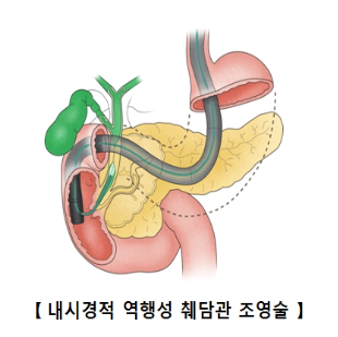 담도암 생존율과 병기별 예후