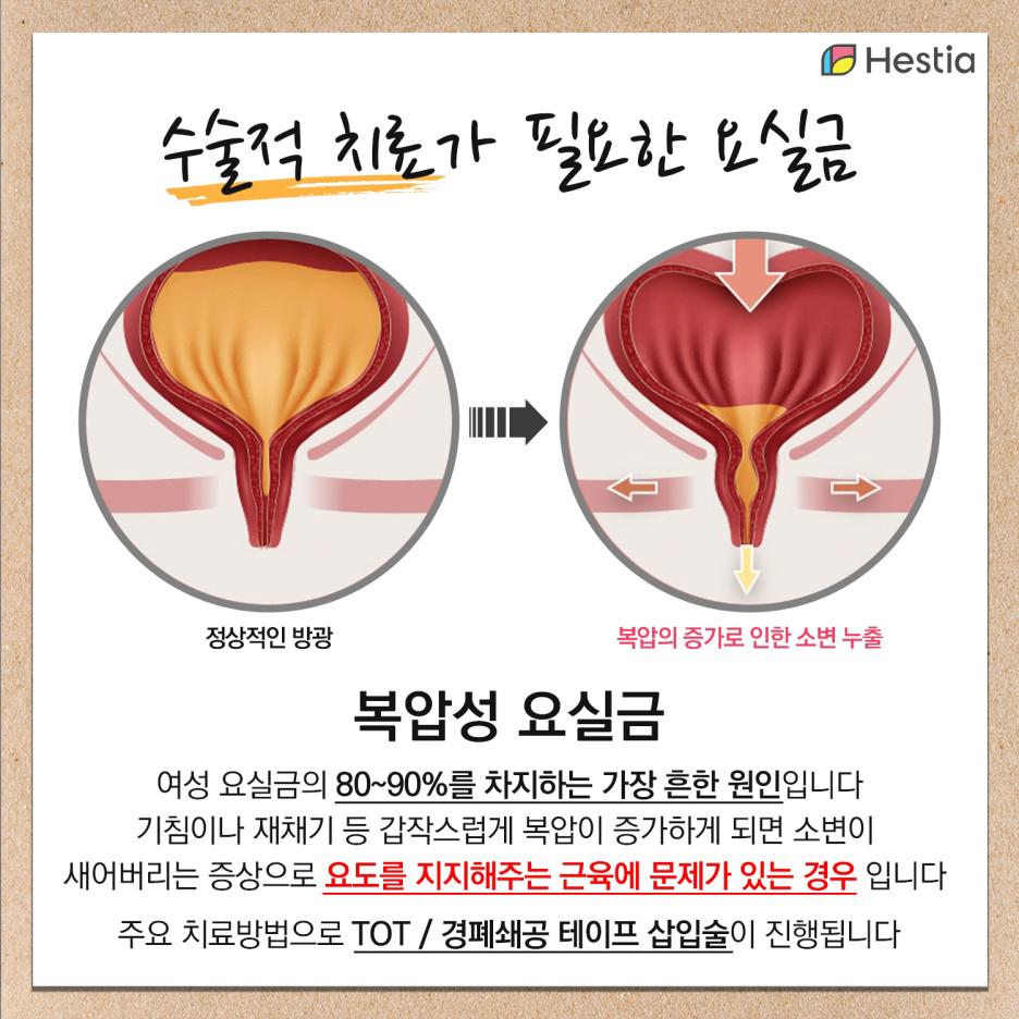 요실금치료 TOT수술이 필요한 복압성 요실금