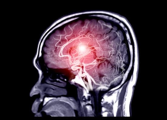 MRA (Magnetic Resonance Angiography): 자기공명 혈관조영술