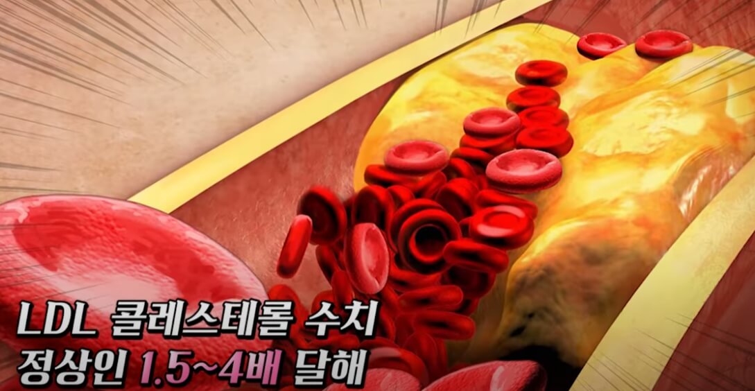 콜레스테롤 낮추는 방법
