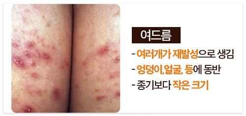 여드름