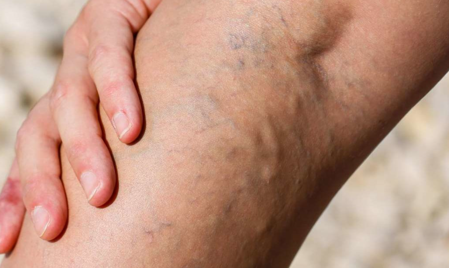 하지정맥류 수술후기